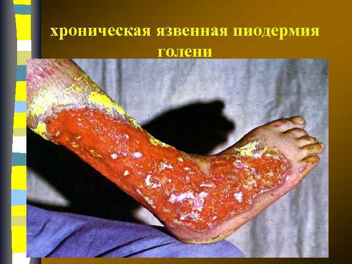 хроническая язвенная пиодермия голени 
