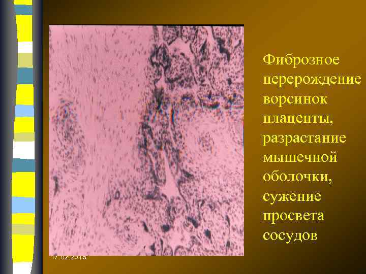 Фиброзное перерождение ворсинок плаценты, разрастание мышечной оболочки, сужение просвета сосудов 17. 02. 2018 