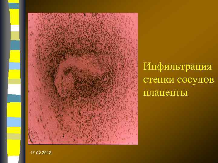 Инфильтрация стенки сосудов плаценты 17. 02. 2018 