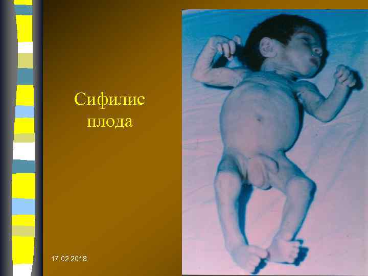 Сифилис плода 17. 02. 2018 