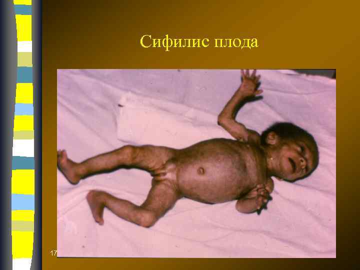 Сифилис плода 17. 02. 2018 