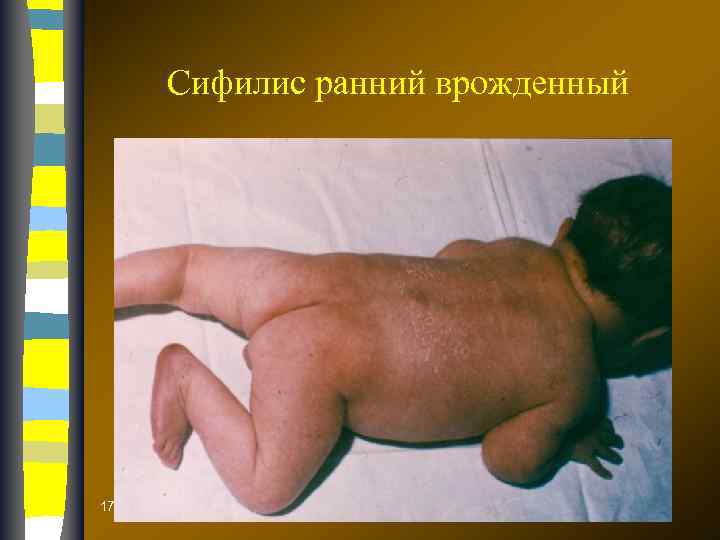 Сифилис ранний врожденный 17. 02. 2018 