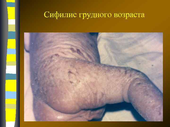 Сифилис грудного возраста 17. 02. 2018 