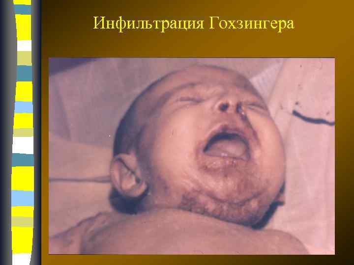 Инфильтрация Гохзингера 17. 02. 2018 