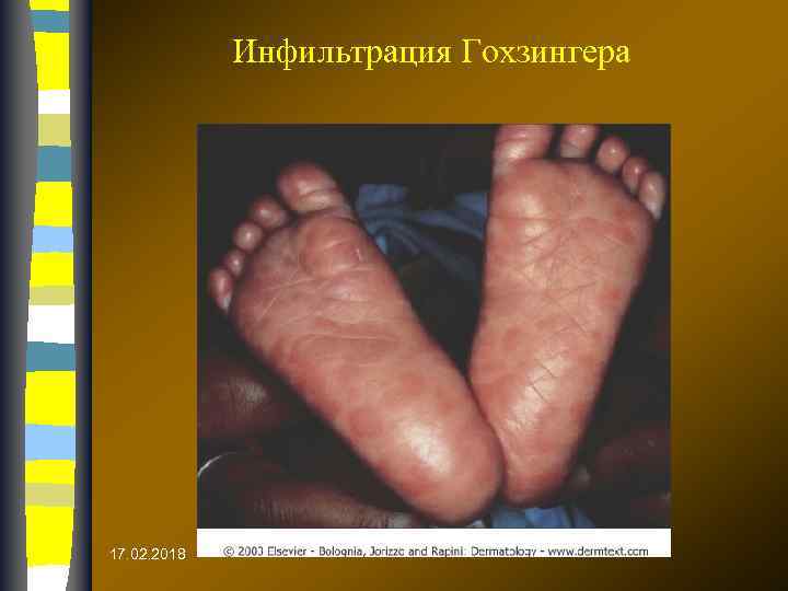 Инфильтрация Гохзингера 17. 02. 2018 