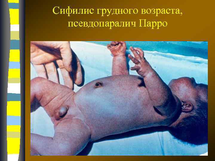 Сифилис грудного возраста, псевдопаралич Парро 17. 02. 2018 