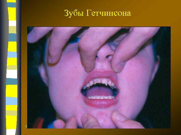 Зубы Гетчинсона 17. 02. 2018 