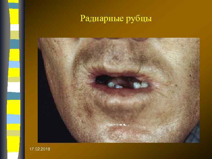 Радиарные рубцы 17. 02. 2018 