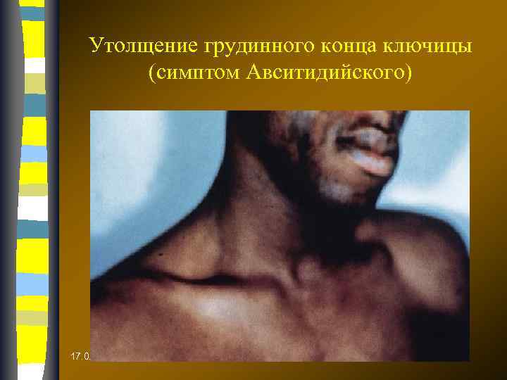 Утолщение грудинного конца ключицы (симптом Авситидийского) 17. 02. 2018 