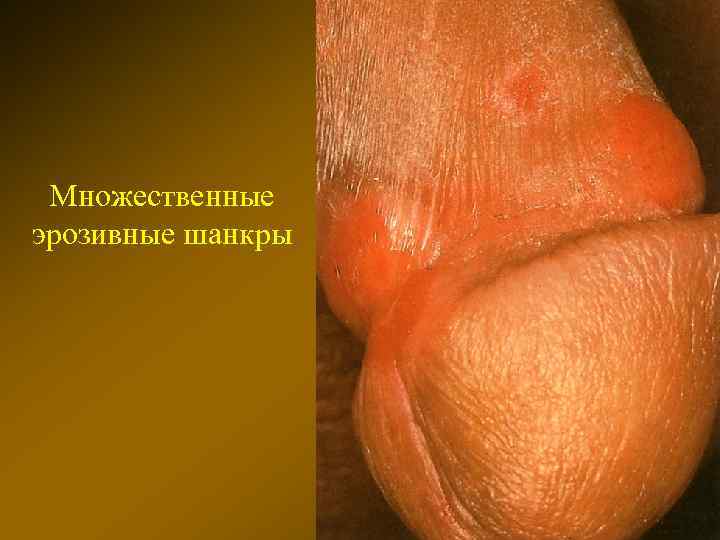 Множественные эрозивные шанкры 