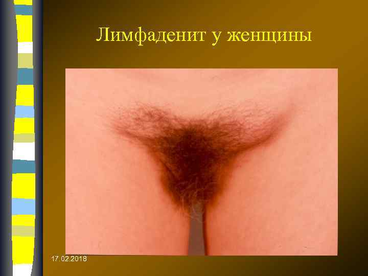 Лимфаденит у женщины 17. 02. 2018 