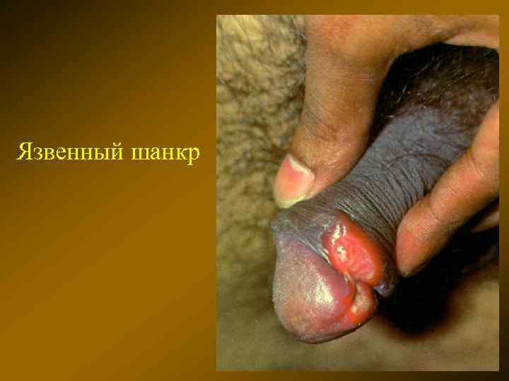 Язвенный шанкр 