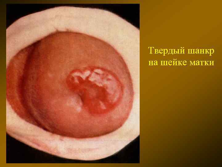 Твердый шанкр на шейке матки 