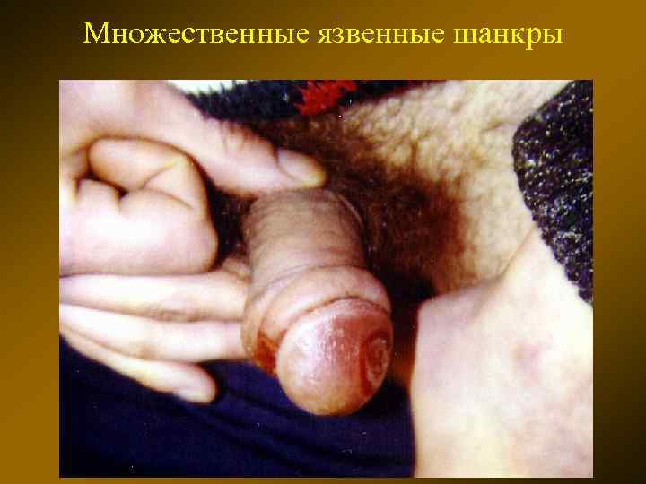 Множественные язвенные шанкры 