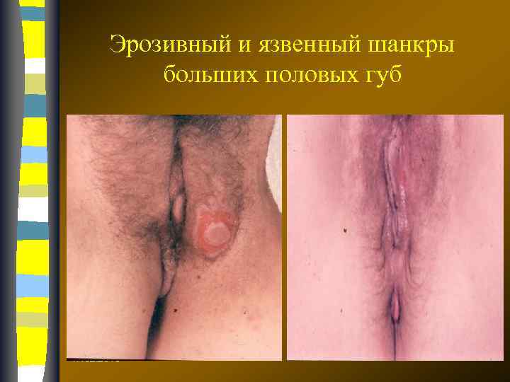 Эрозивный и язвенный шанкры больших половых губ 17. 02. 2018 