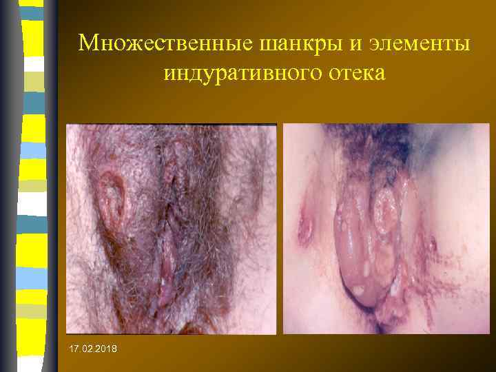 Множественные шанкры и элементы индуративного отека 17. 02. 2018 