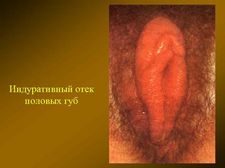 Индуративный отек половых губ 