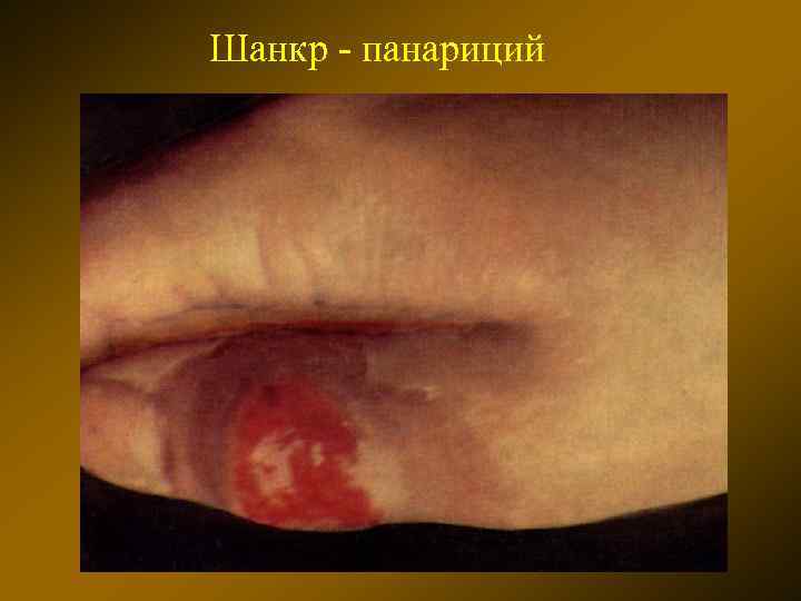 Шанкр - панариций 