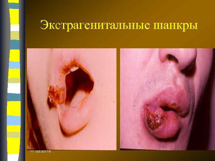 Экстрагенитальные шанкры 17. 02. 2018 