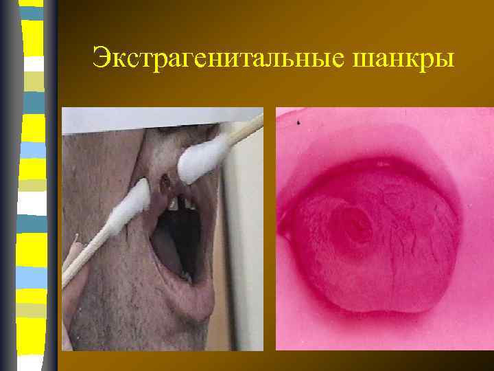 Экстрагенитальные шанкры 17. 02. 2018 