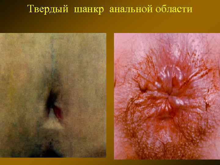 Твердый шанкр анальной области 