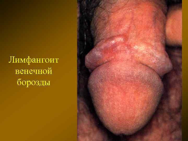 Лимфангоит венечной борозды 