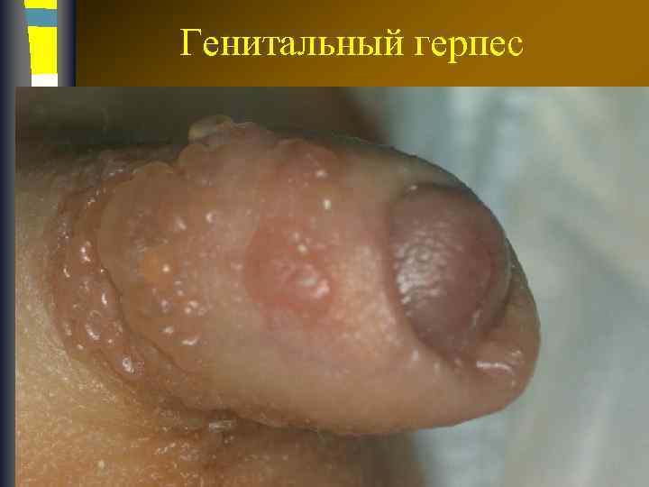 Генитальный герпес 