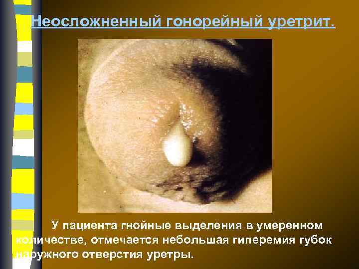 Неосложненный гонорейный уретрит. У пациента гнойные выделения в умеренном количестве, отмечается небольшая гиперемия губок