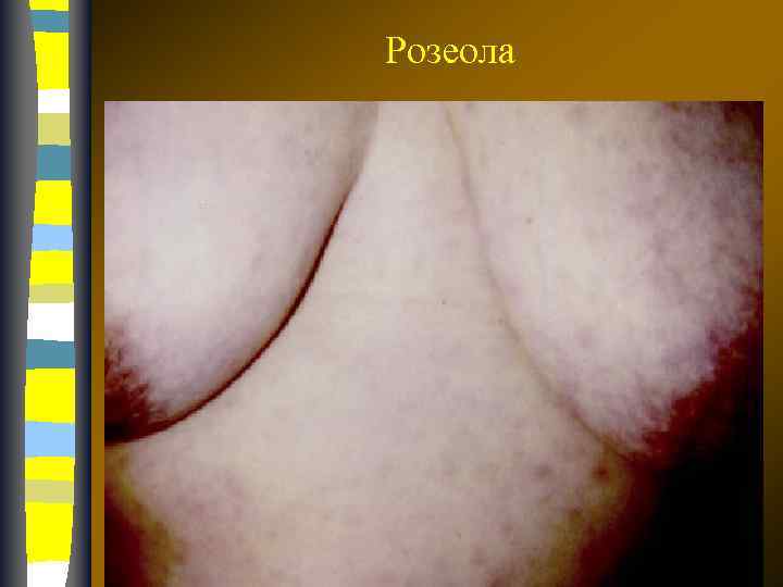 Розеола 17. 02. 2018 