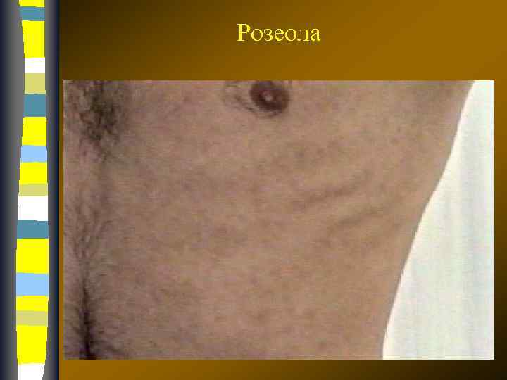 Розеола 17. 02. 2018 