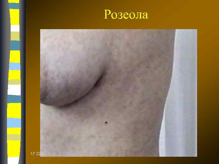 Розеола 17. 02. 2018 