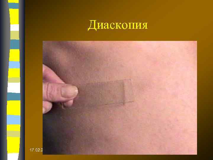 Диаскопия 17. 02. 2018 