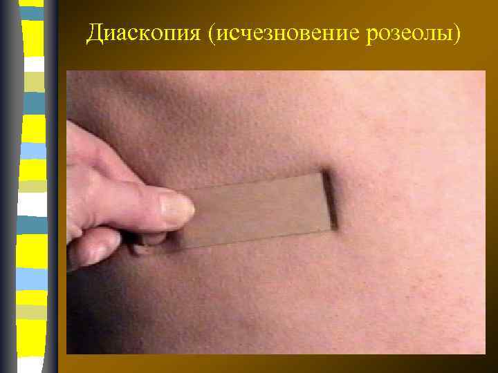 Диаскопия (исчезновение розеолы) 17. 02. 2018 