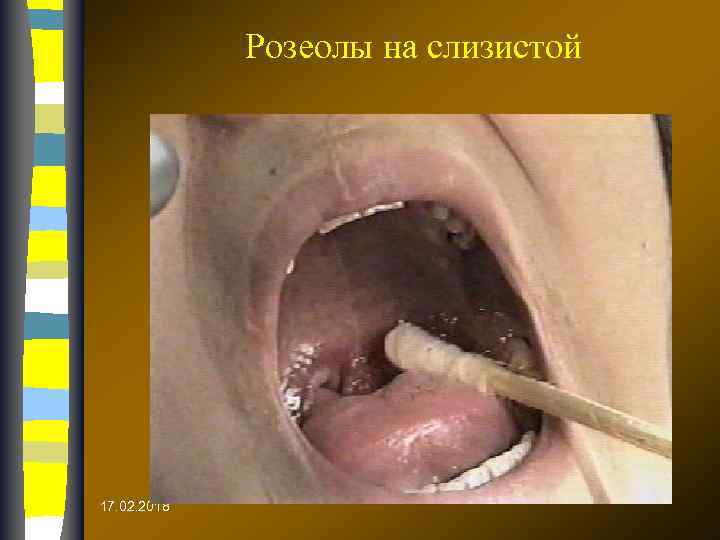 Розеолы на слизистой 17. 02. 2018 