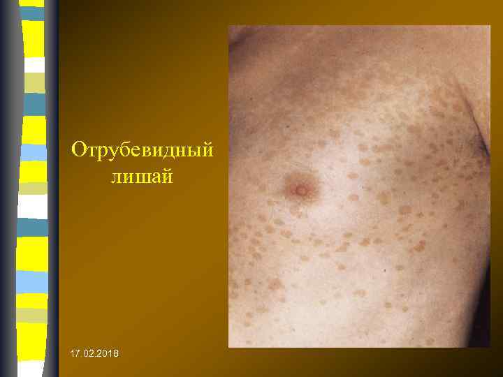 Отрубевидный лишай 17. 02. 2018 