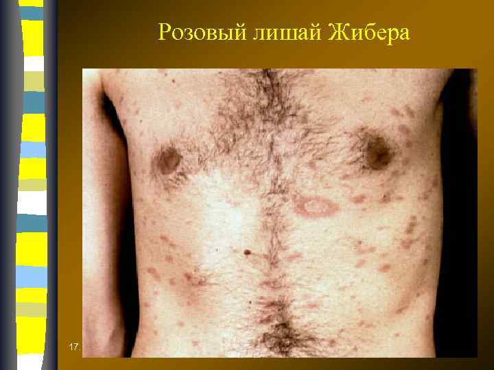 Розовый лишай Жибера 17. 02. 2018 