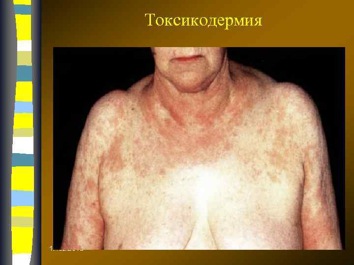 Токсикодермия 17. 02. 2018 