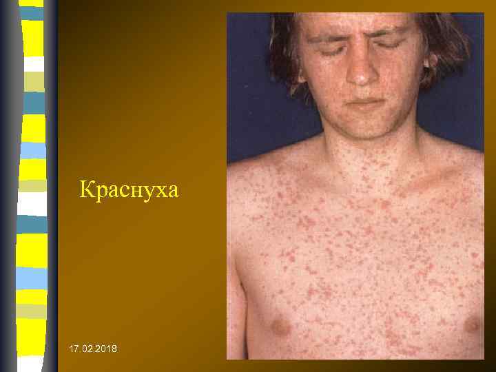 Краснуха 17. 02. 2018 
