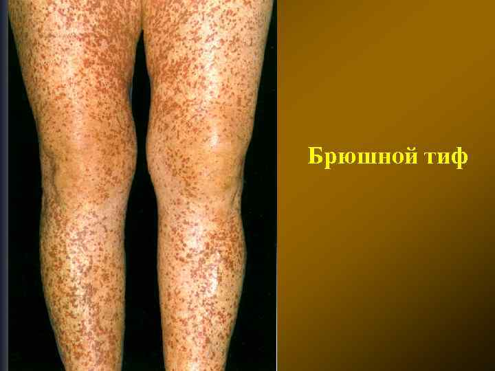 Брюшной тиф 