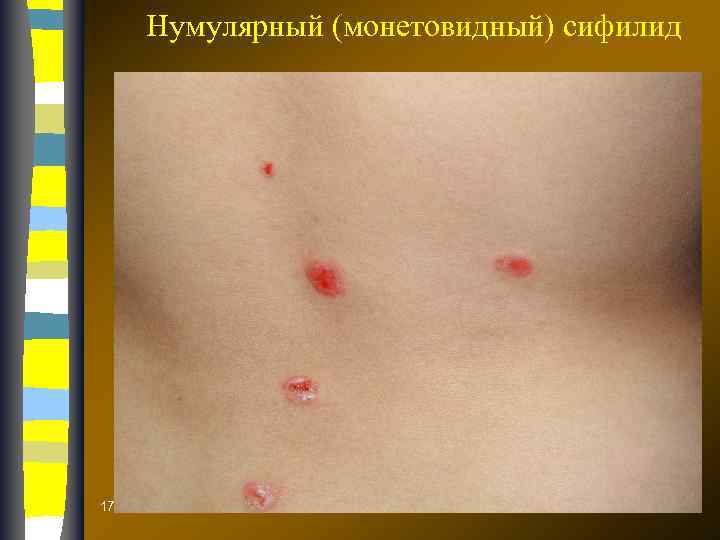 Нумулярный (монетовидный) сифилид 17. 02. 2018 