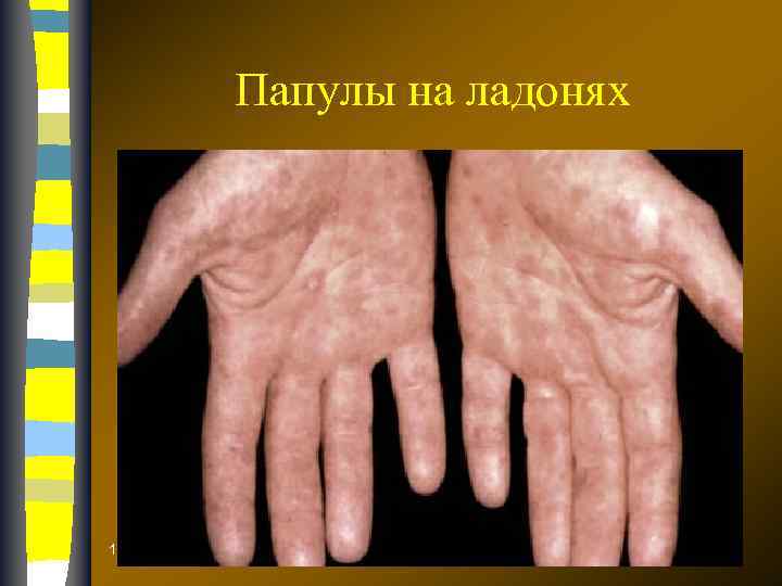 Папулы на ладонях 17. 02. 2018 