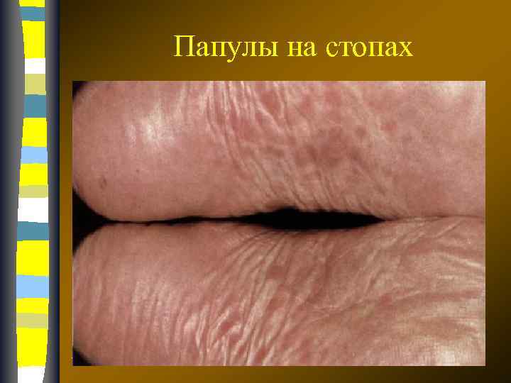 Папулы на стопах 17. 02. 2018 