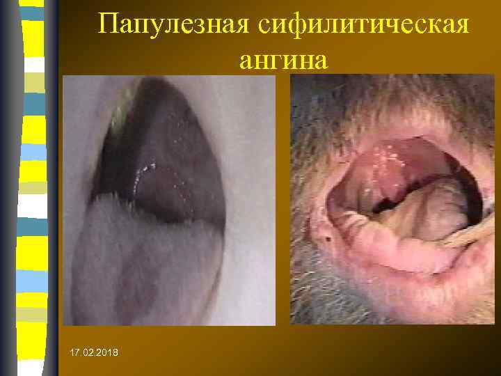 Папулезная сифилитическая ангина 17. 02. 2018 