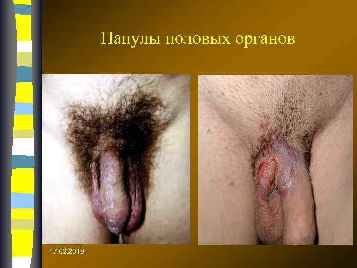 Папулы половых органов 17. 02. 2018 