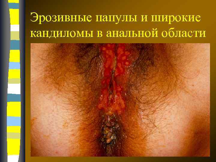 Эрозивные папулы и широкие кандиломы в анальной области 17. 02. 2018 