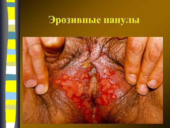 Эрозивные папулы 17. 02. 2018 