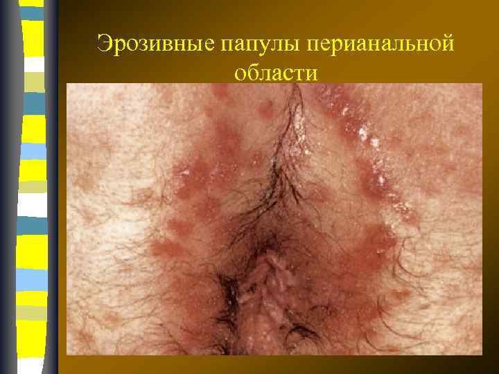Эрозивные папулы перианальной области 17. 02. 2018 