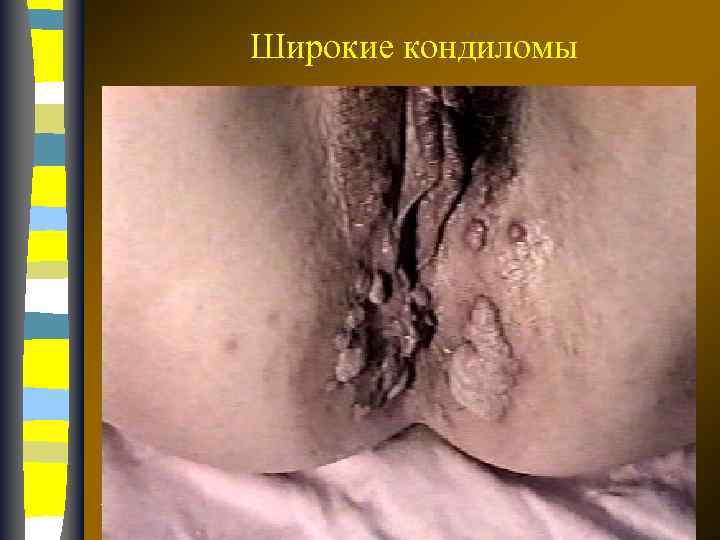 Широкие кондиломы 17. 02. 2018 