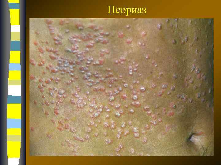 Псориаз 17. 02. 2018 