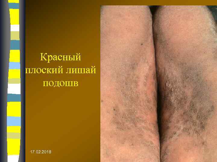 Красный плоский лишай подошв 17. 02. 2018 